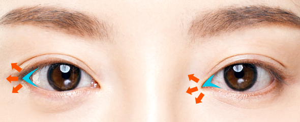 canthoplasty korea - Epicanthoplasty in Korea