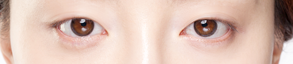 ptosis correction korea - Ptosis Correction in Korea