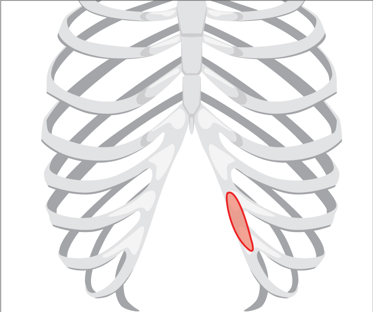 Autologous costal cartilage