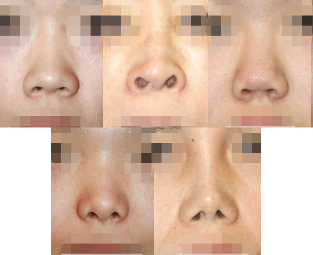 Classification of wide noses