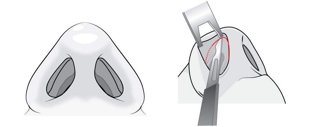 Method of Closed Surgery