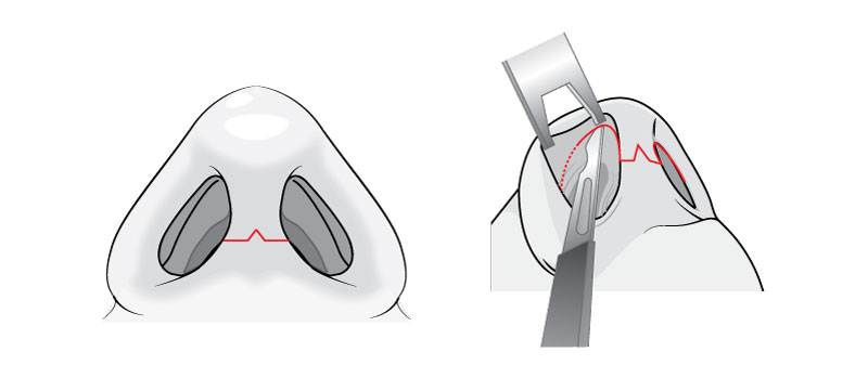 Method of Open Surgery