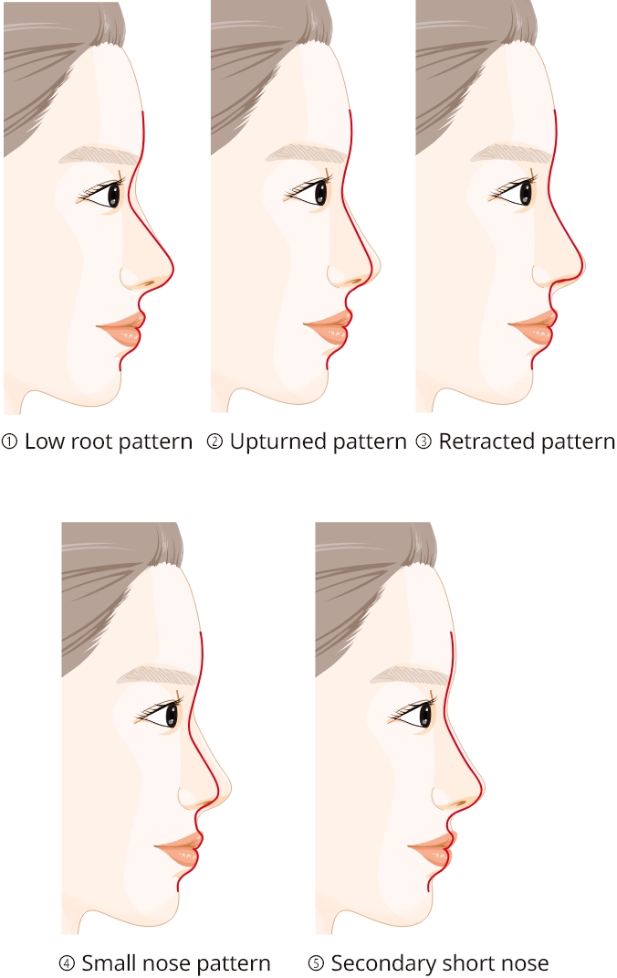 Short nose classification