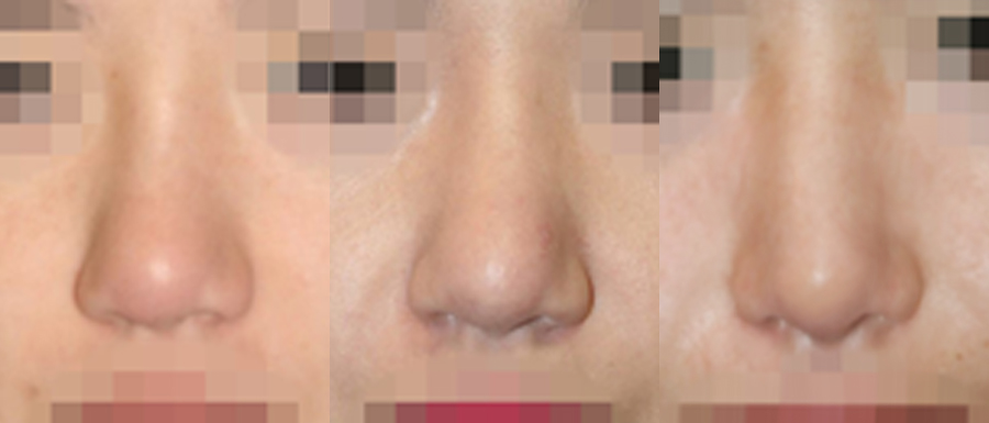 Nose re-correction