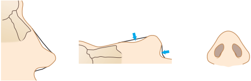 Saddle Nose