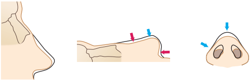 Saddle Nose