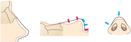 Saddle Nose