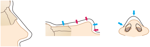 Saddle Nose