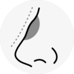 rhinoplasty in korea the plus plastic surgery gangnam