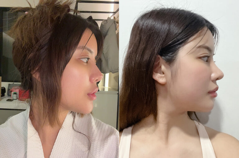 Soda’s Real Review|Follow my 3-months journey after revision rhinoplasty