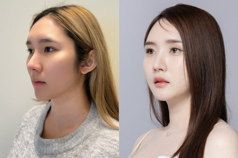 Milk’s Real Review | My Face Contouring Experience in Korea: Forehead Lift, Fat Grafting, Zygoma Reduction