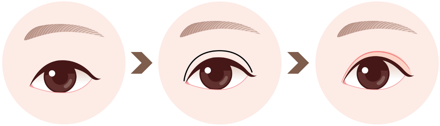 double eyelid surgery in Korea the plus plastic surgery gangnam