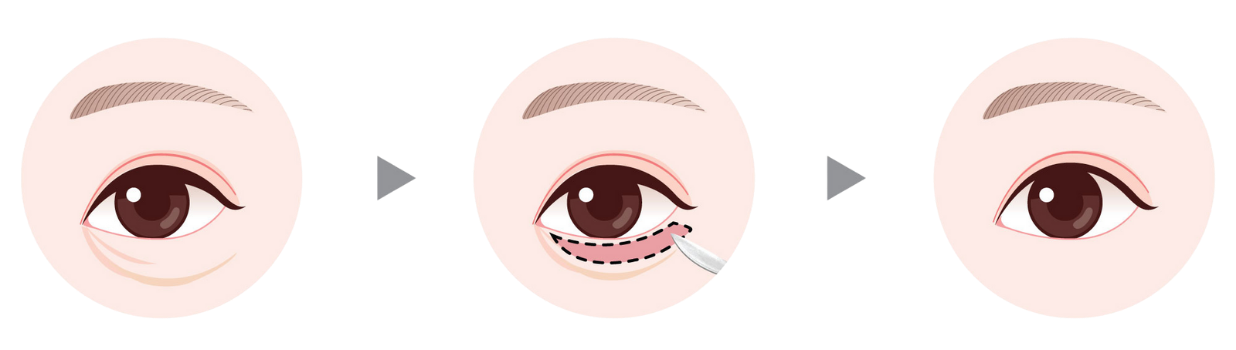 blepharoplasty in Korea the plus plastic surgery gangnam