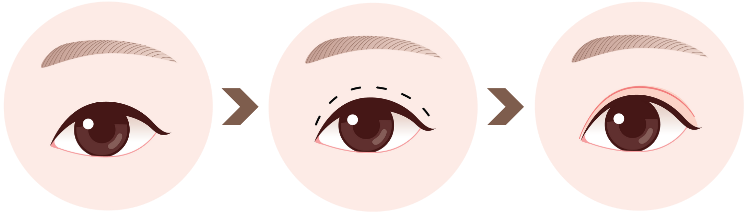 double eyelid surgery in Korea the plus plastic surgery gangnam