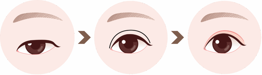 ptosis correction in Korea the plus plastic surgery gangnam