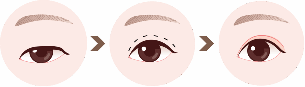 ptosis correction in Korea the plus plastic surgery gangnam