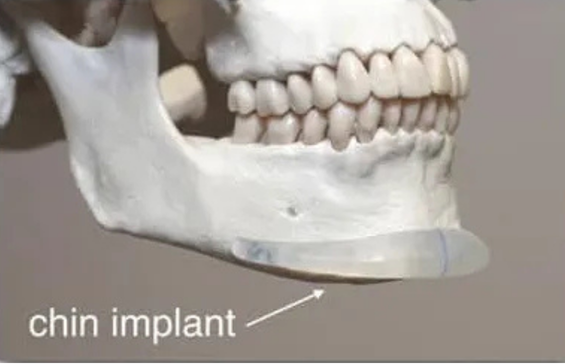 face implant surgery in Korea the plus plastic surgery gangnam
