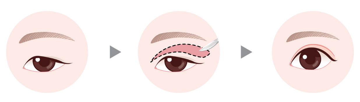 blepharoplasty in Korea the plus plastic surgery gangnam