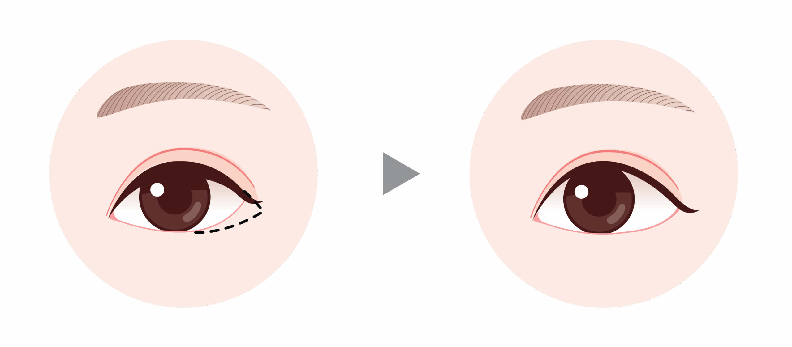 canthoplasty in Korea the plus plastic surgery gangnam