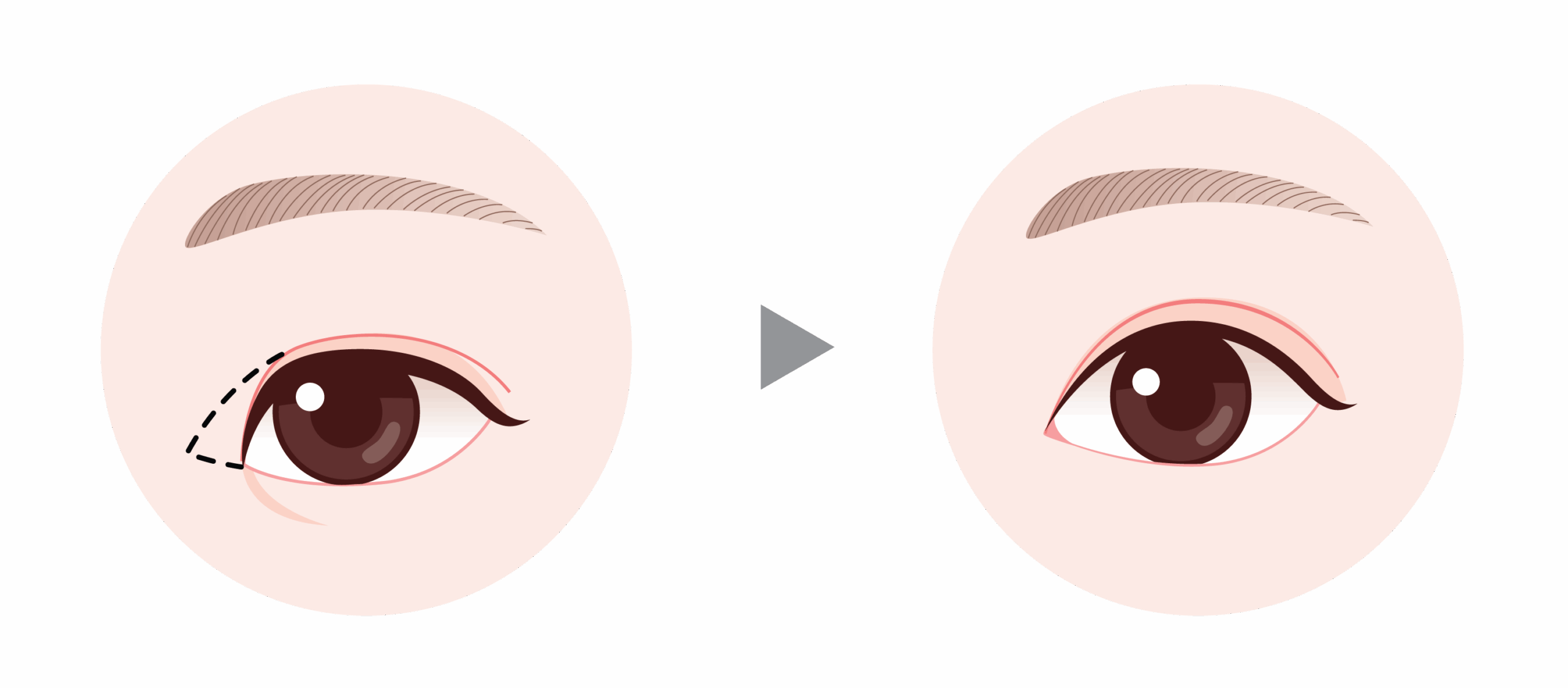 canthoplasty in Korea the plus plastic surgery gangnam