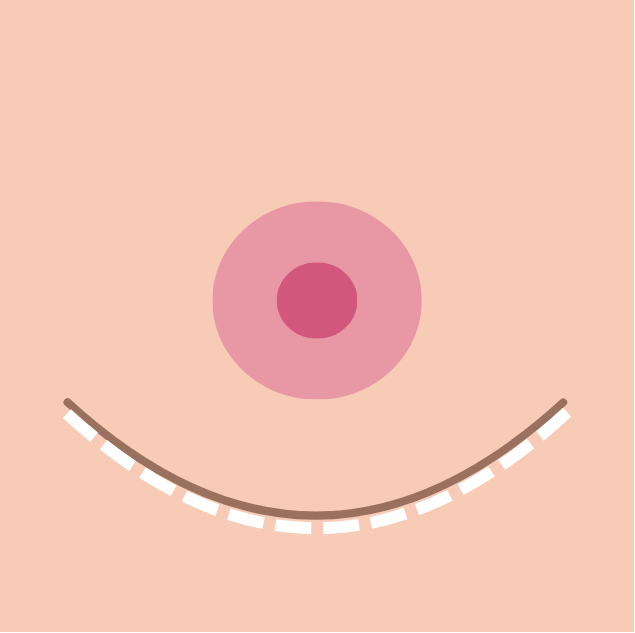 breast reduction in korea the plus plastic surgery gangnam seoul