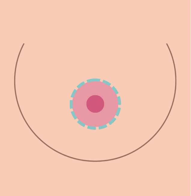 breast lift in korea the plus plastic surgery gangnam seoul