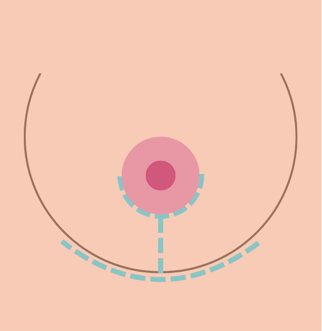 breast reduction in korea the plus plastic surgery gangnam seoul