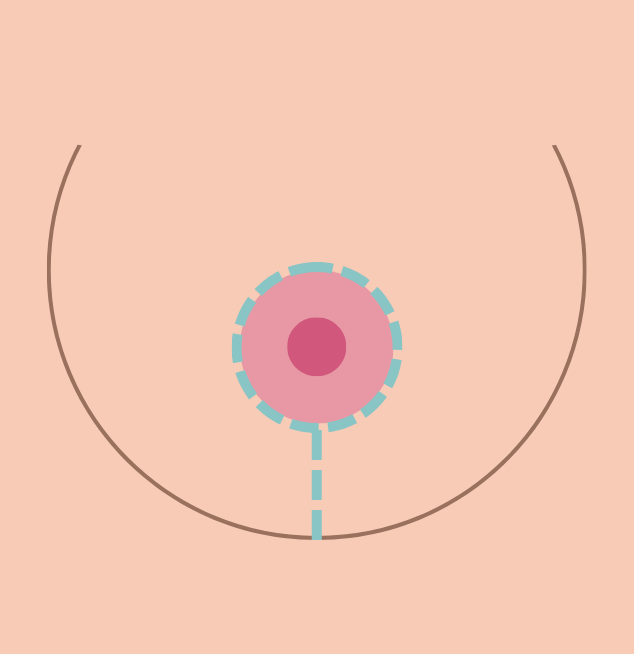 breast reduction in korea the plus plastic surgery gangnam seoul
