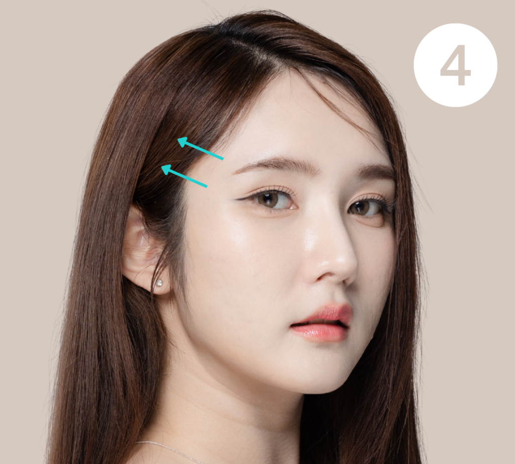 Temporal lift - Facelift at The Plus Plastic Surgery in Korea, Seoul (Gangnam).
