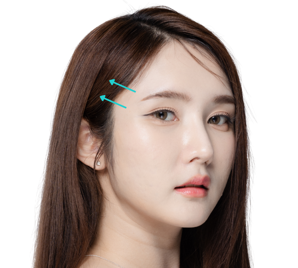 Temporal Thread Lift - Non-Permanent Foxy Eye Lift - Thread Lift at The Plus Plastic Surgery in Gangnam, Korea.